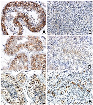 Changes in adhesion molecules: β-catenin, E-cadherin and Galectin-3 in cells of testicular seminoma